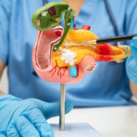 Pancreatic Cancer Treatment Breakthrough Extends Survival